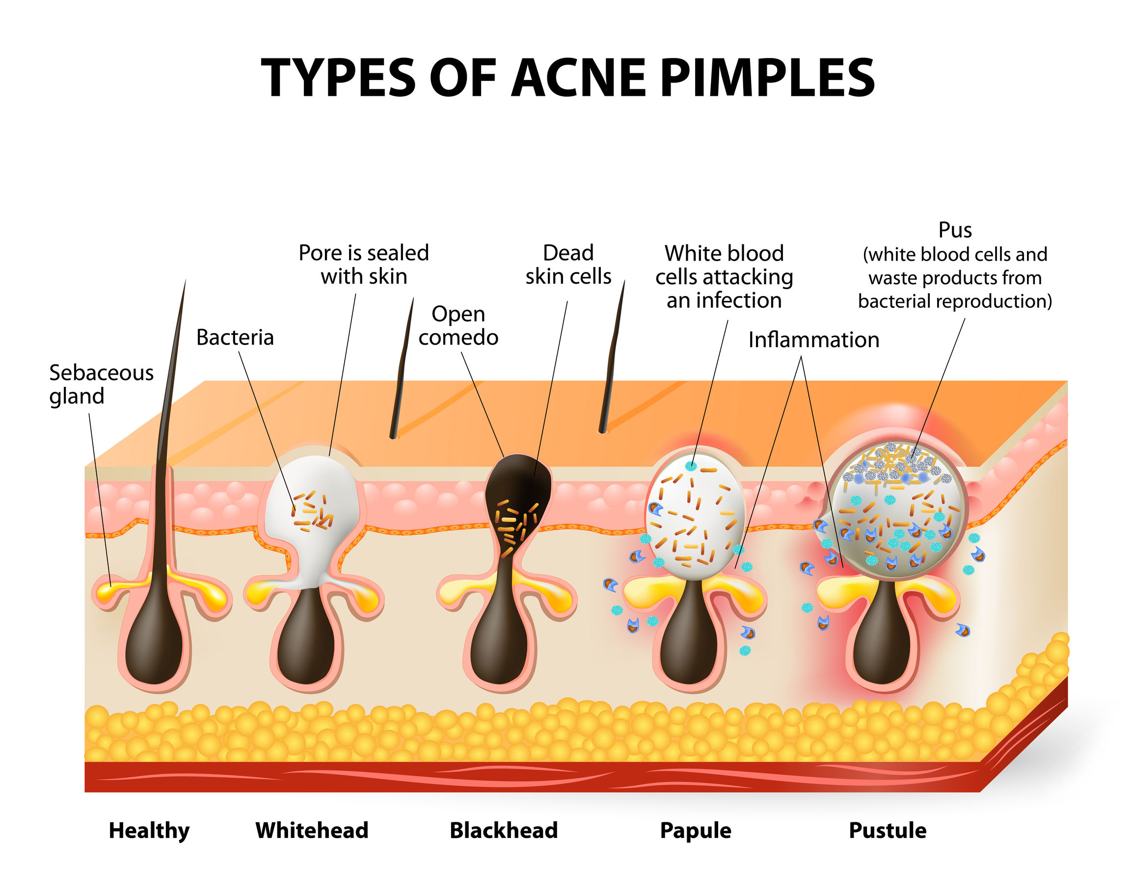 Types of Acne Acne Prone Skin Care