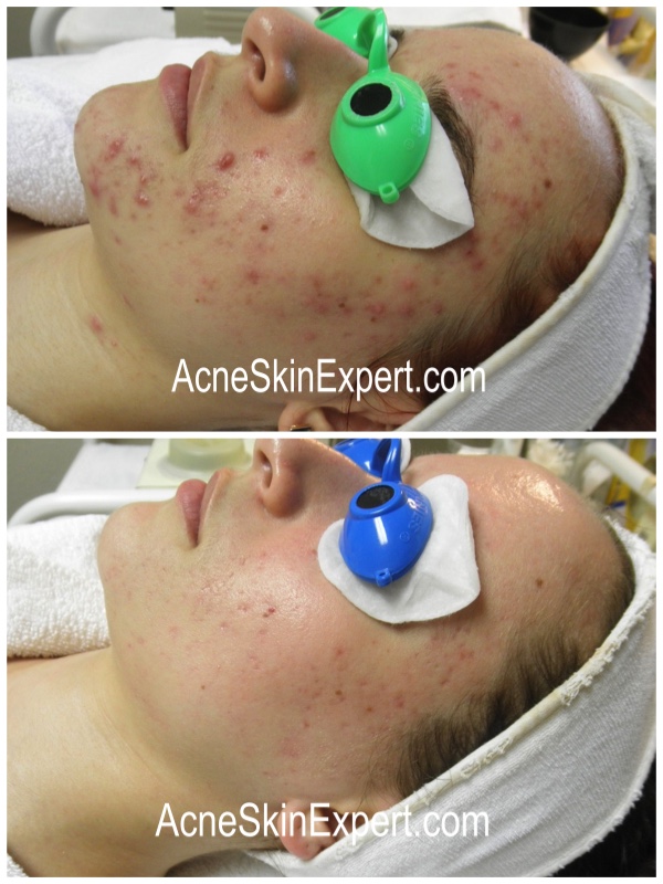 combination-acne-treatment-AcneSkinExpert.com
