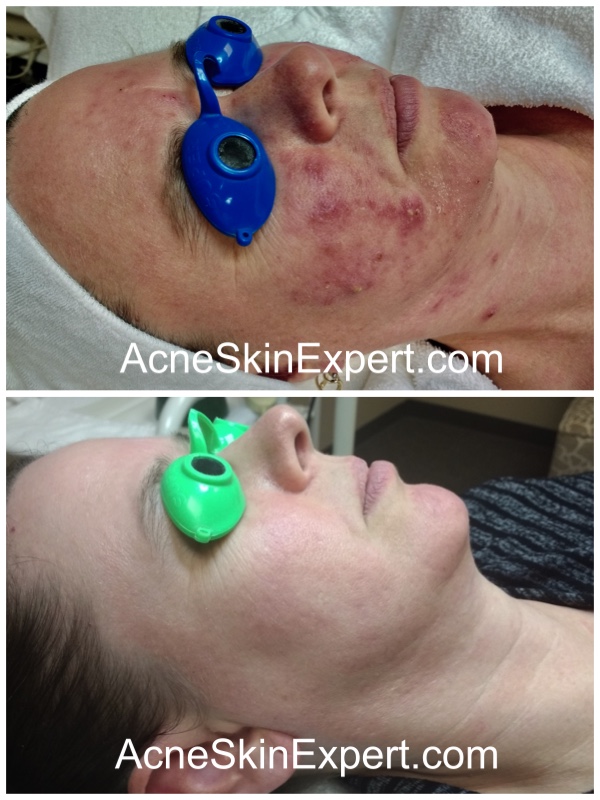 inflamed-acne-skin-treatment-AcneSkinExpert.com