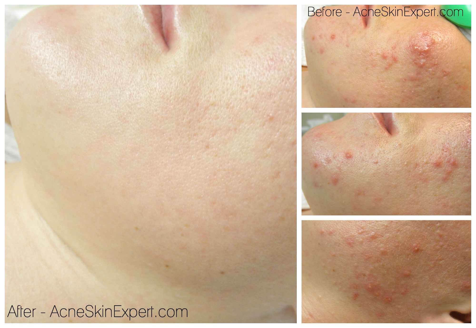 acne-help: AcneSkinExpert.com