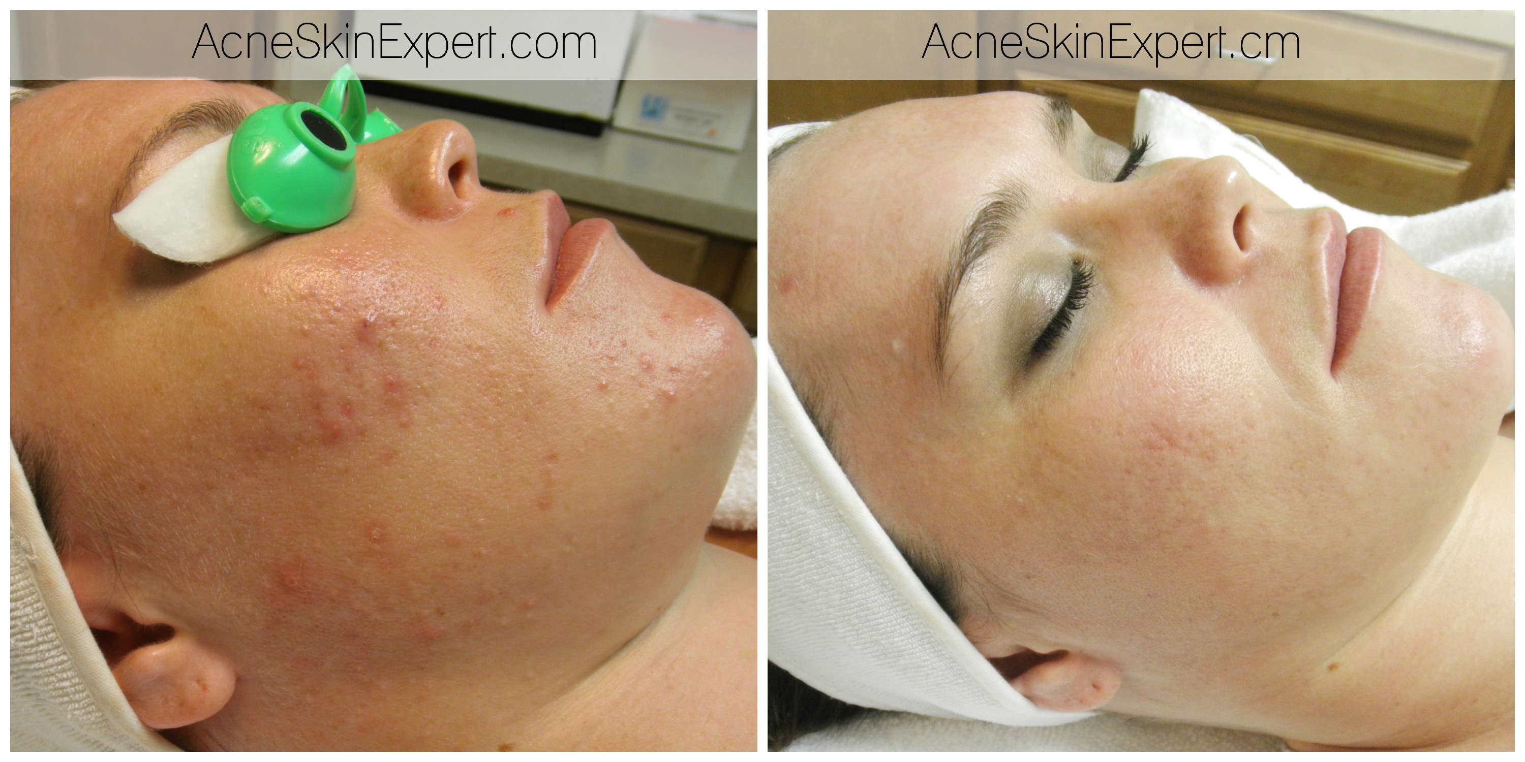 acne-treatment-oily-combination-AcneSkinExpert.com
