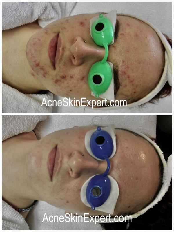 combination-acne-treatment-AcneSkinExpert.com