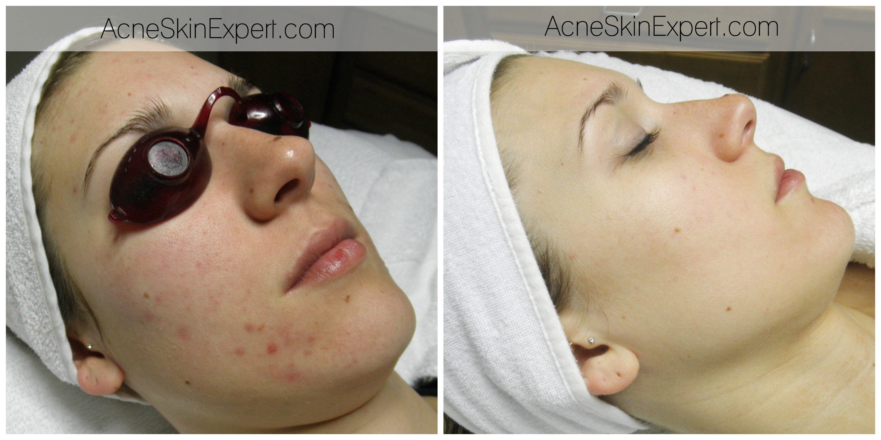 acne-sensitive-skin-treatment-AcneSkinExpert.com