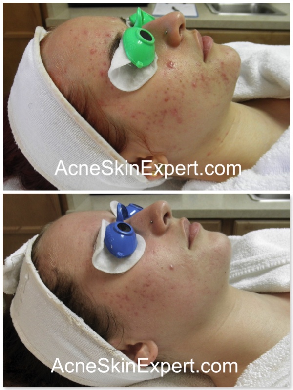 combination-acne-treatment-AcneSkinExpert.com