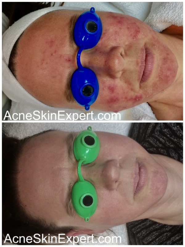 inflamed-acne-skin-treatment-AcneSkinExpert.com