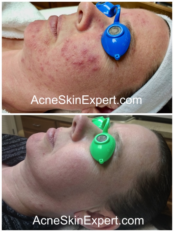 inflamed-acne-skin-treatment-AcneSkinExpert.com