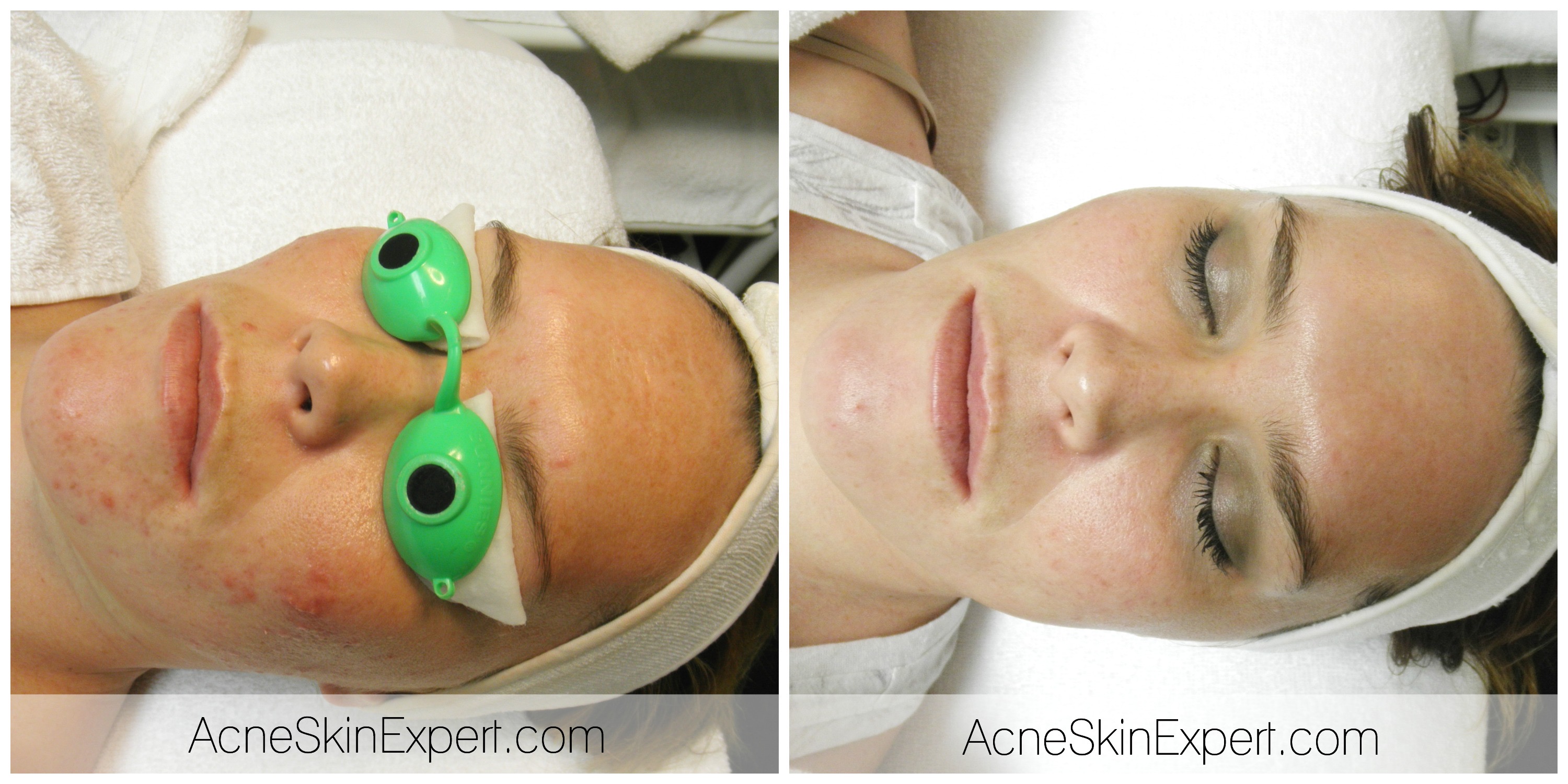 acne-treatment-oily-combination-AcneSkinExpert.com