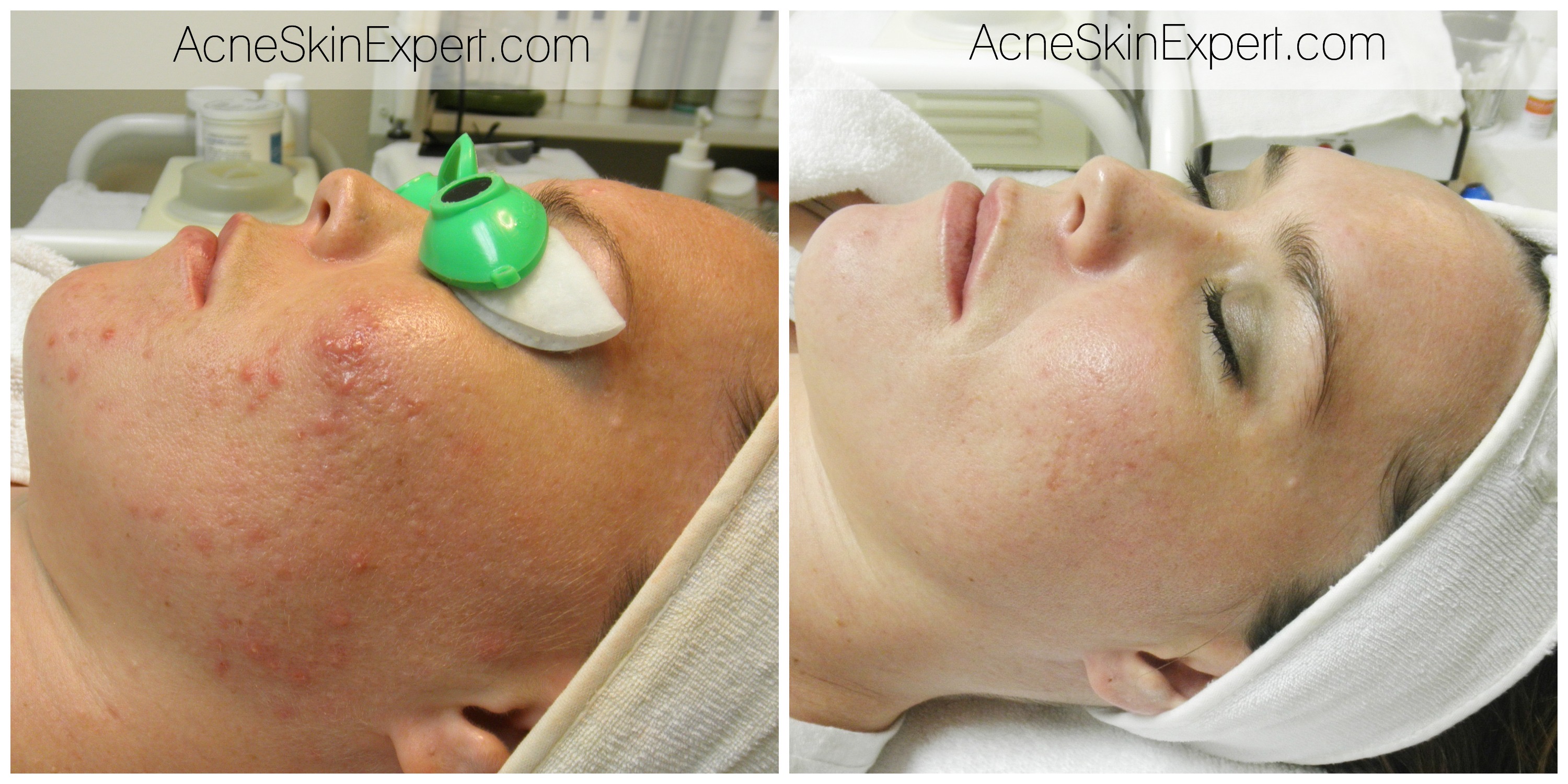 acne-treatment-oily-combination-AcneSkinExpert.com