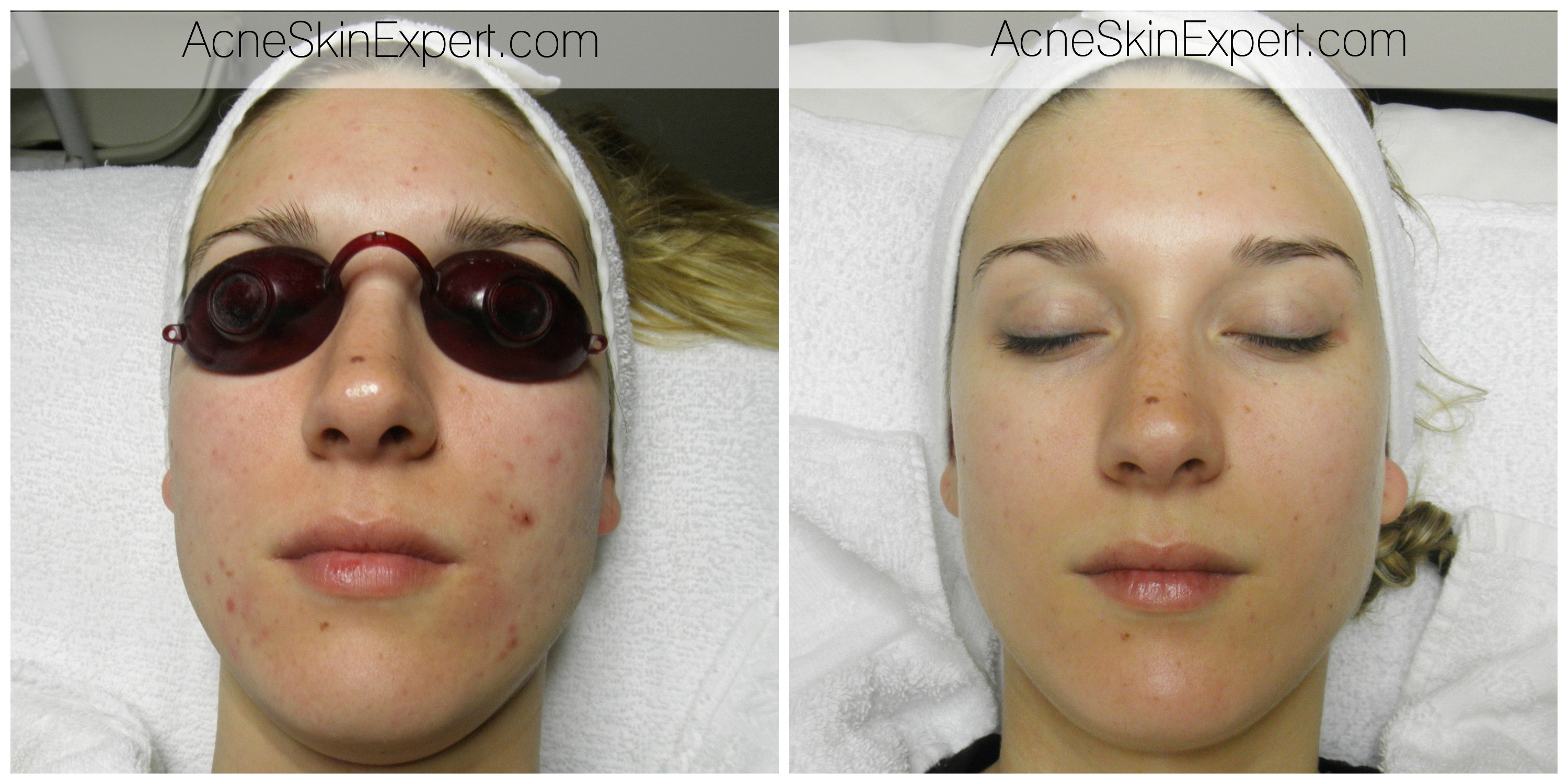 acne-sensitive-skin-treatment-AcneSkinExpert.com