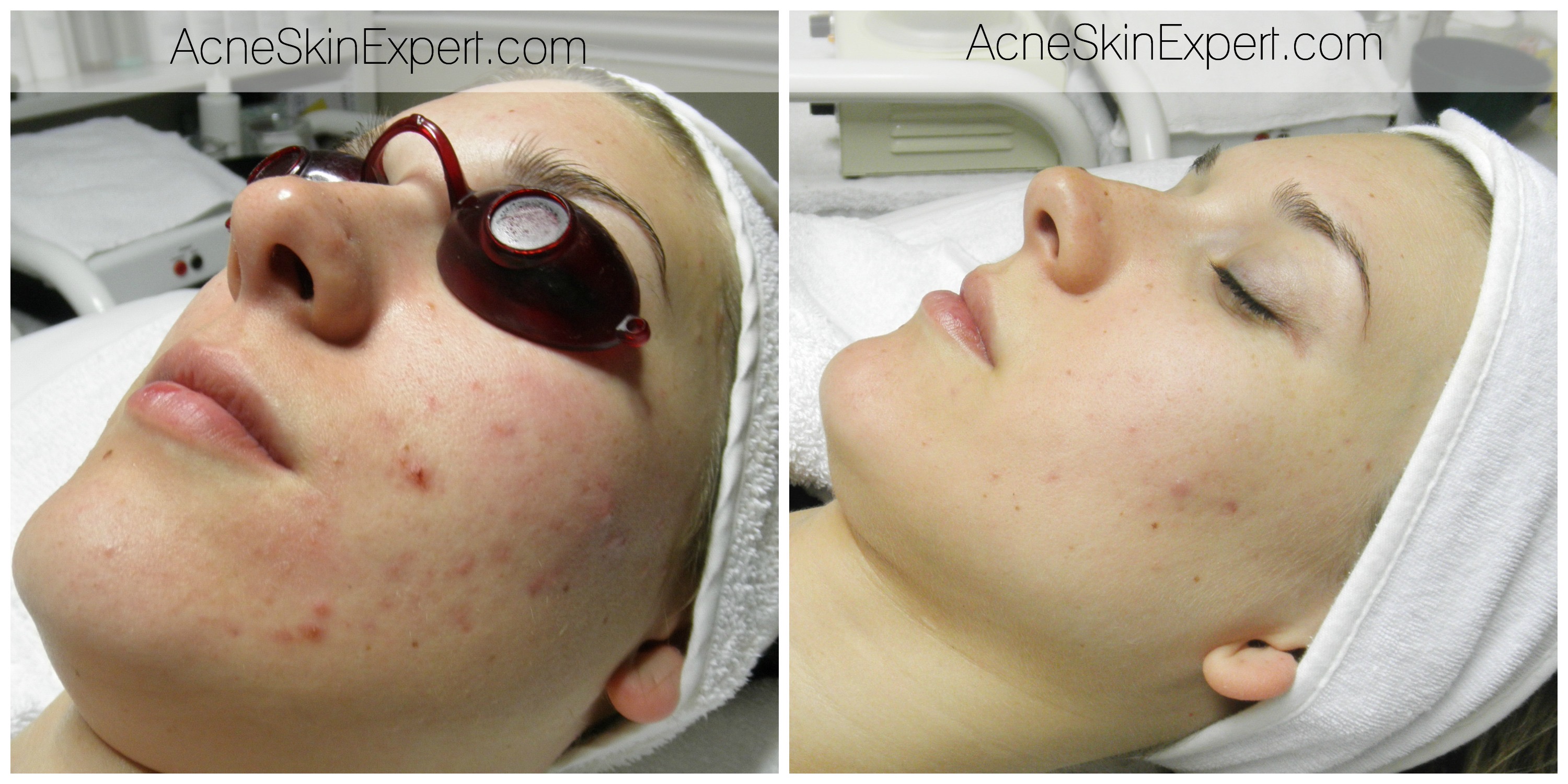 acne-sensitive-skin-treatment-AcneSkinExpert.com