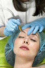 microdermabrasion acne treatment